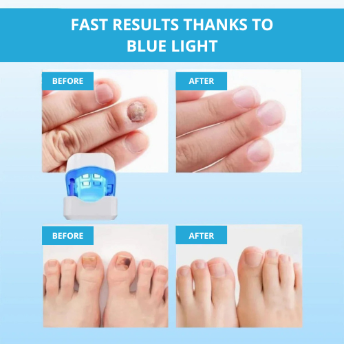 LaserNail Pro | Treatment Against Funghis